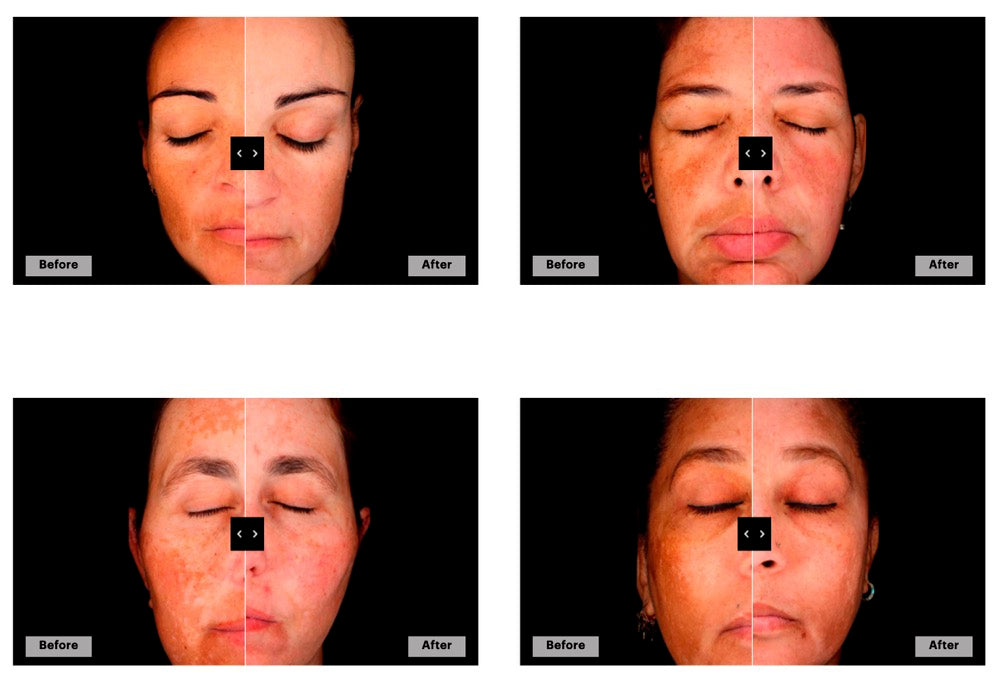 Mesoestetic Dermamelan Pack (6 Items)